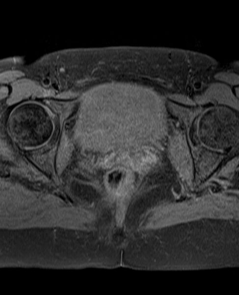File:Adult granulosa cell tumor of the ovary (Radiopaedia 71581-81950 Axial T1 fat sat 21).jpg