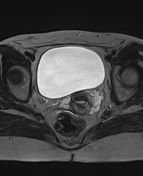 File:Adult granulosa cell tumor of the ovary (Radiopaedia 71581-81950 Axial T2 18).jpg