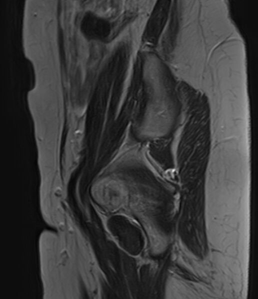 File:Adult granulosa cell tumor of the ovary (Radiopaedia 71581-81950 Sagittal T2 21).jpg