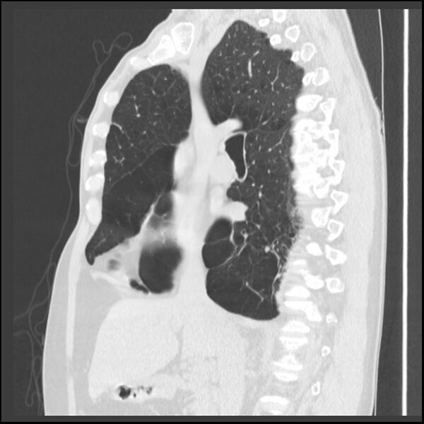 File:Alpha-1-antitrypsin deficiency (Radiopaedia 40993-43722 Sagittal lung window 153).jpg