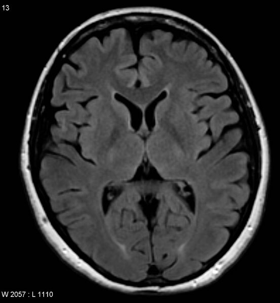 File:Amyotrophic lateral sclerosis (Radiopaedia 5373-7134 Axial FLAIR 13).jpg
