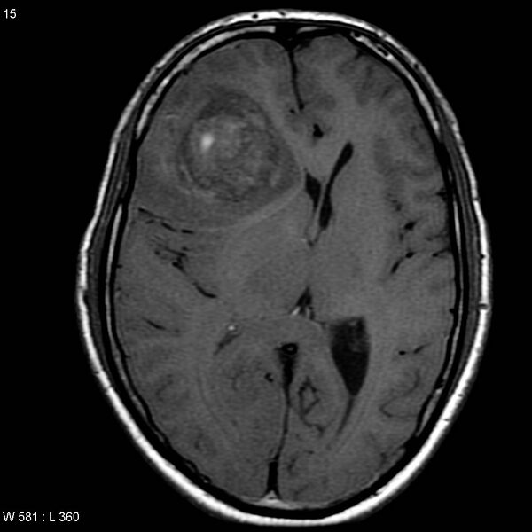 File:Anaplastic oligodendroglioma NOS (hemorrhagic) (Radiopaedia 5418-7169 Axial T1 1).jpg