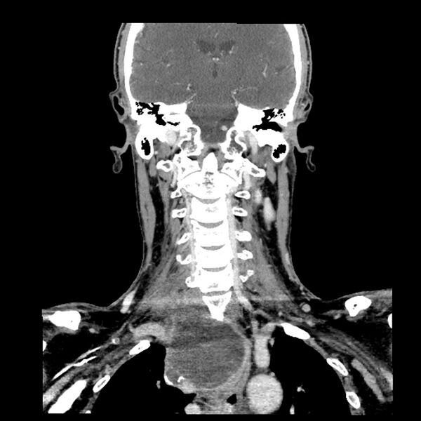 File:Anaplastic thyroid carcinoma (Radiopaedia 79087-92034 A 74).jpg