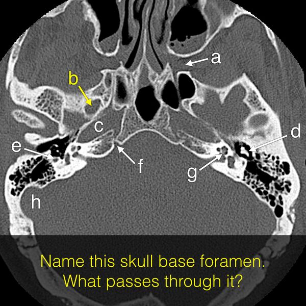 File:Anatomy Quiz (Skull base) (Radiopaedia 41833-44822 Axial 4).jpeg