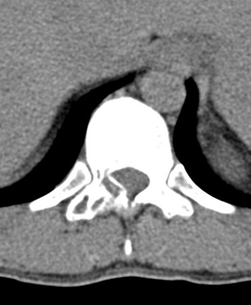 File:Aneurysmal bone cyst T11 (Radiopaedia 29294-29721 Axial non-contrast 40).jpg