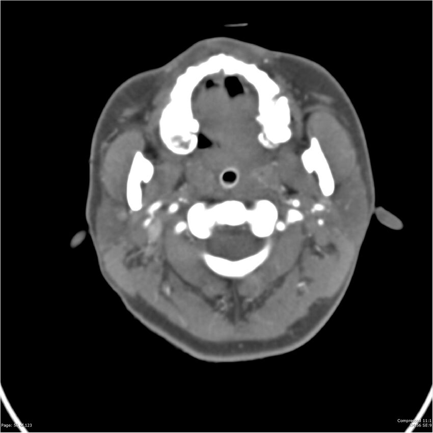 Aneurysmal subarachnoid hemorrhage and Moya Moya disease (Radiopaedia 34306-35593 Axial CT COW 56).jpg