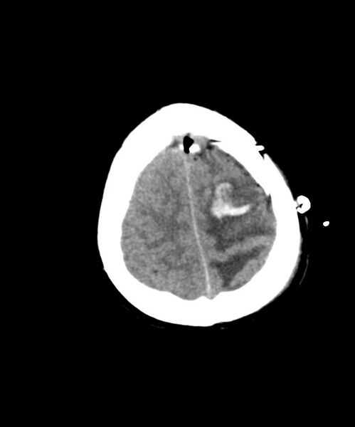 File:Angiomatous meningioma (Radiopaedia 79459-92578 Axial non-contrast 26).jpg