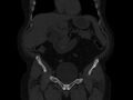 Ankylosing spondylitis (Radiopaedia 44609-48357 Coronal bone window 8).jpg