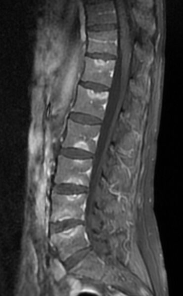 File:Ankylosing spondylitis - Andersson lesion (Radiopaedia 81878-95838 F 6).jpg