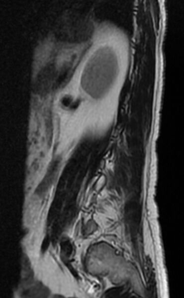File:Ankylosing spondylitis - Andersson lesion (Radiopaedia 81878-95838 Sagittal T2 12).jpg