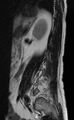 Ankylosing spondylitis - Andersson lesion (Radiopaedia 81878-95838 Sagittal T2 12).jpg