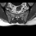 Ankylosing spondylitis with zygapophyseal arthritis (Radiopaedia 38433-40517 B 9).jpg