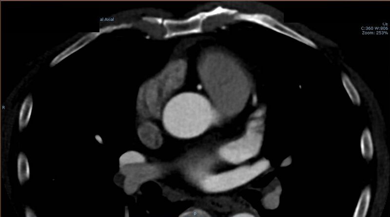 File:Anomalous left coronary artery- prepulmonic course (Radiopaedia 29253-29667 A 6).JPG