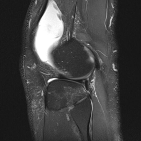 File:Anterior cruciate ligament tear - ramp lesion (Radiopaedia 71883-82322 Sagittal PD fat sat 5).jpg
