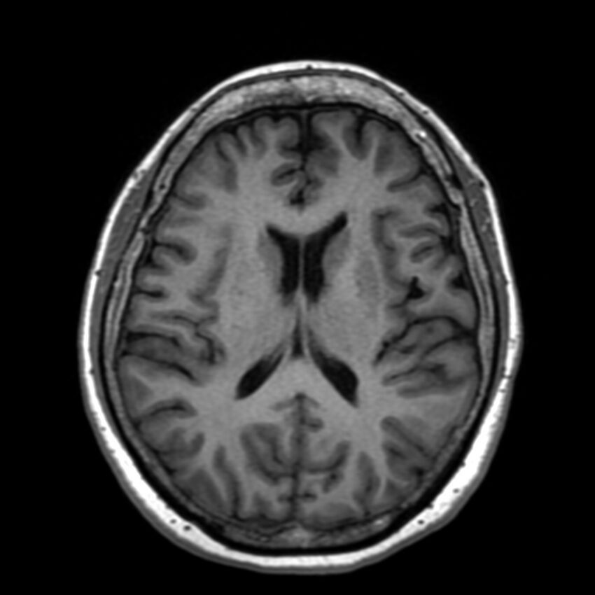 Anti-MOG encephalomyelitis (Radiopaedia 73831-84646 Axial T1 30).jpg