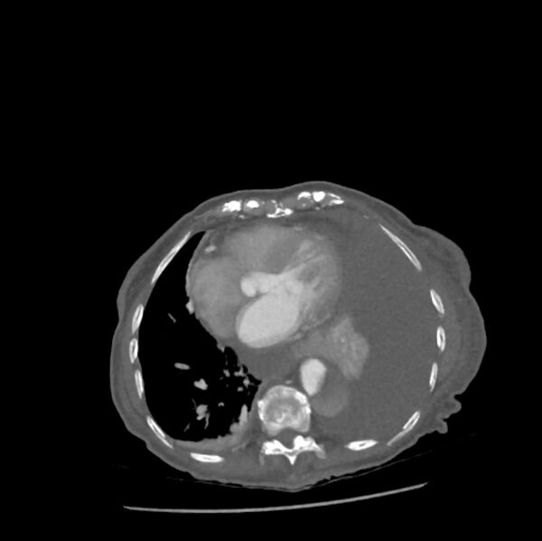 File:Aortic dissection (Radiopaedia 68763-78691 A 38).jpeg