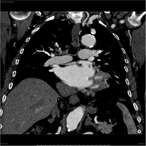 File:Aortic dissection - Stanford type A (Radiopaedia 26183-26315 A 35).jpg