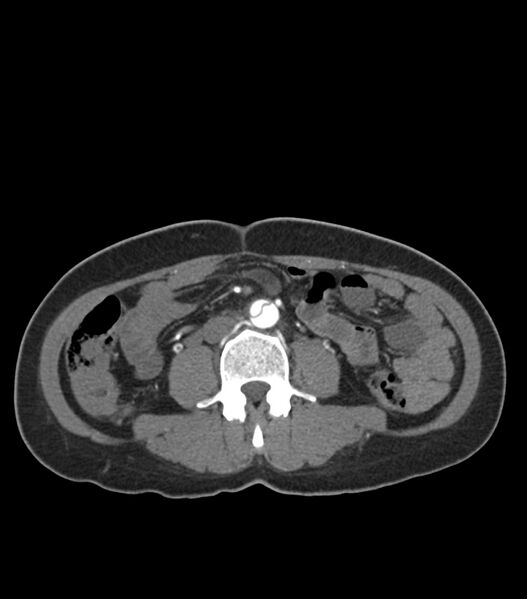 File:Aortic dissection with renal ischemia (Radiopaedia 76573-88338 A 82).jpg
