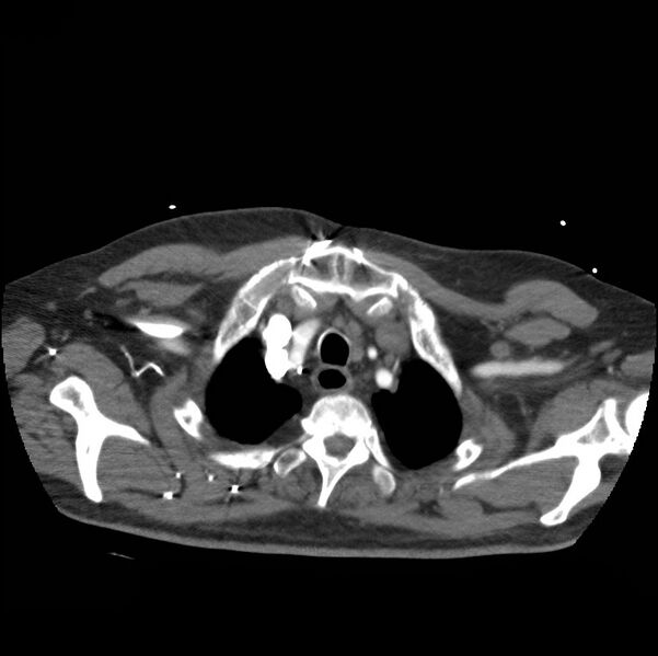File:Aortic dissection with rupture into pericardium (Radiopaedia 12384-12647 A 9).jpg