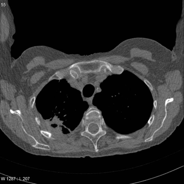 File:Apical non-small-cell lung cancer (Radiopaedia 8570-9405 Axial non-contrast 7).jpg