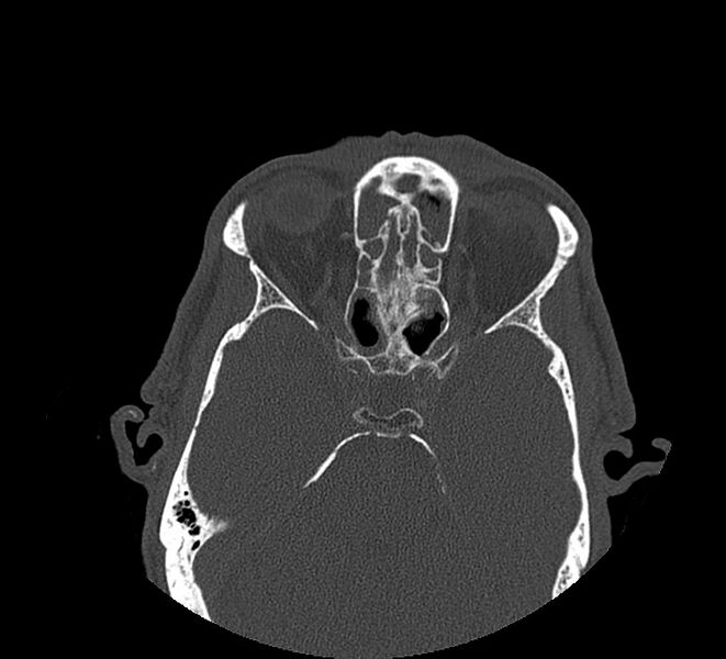 File:Aplastic maxillary sinuses (Radiopaedia 60030-67561 Axial non-contrast 52).jpg