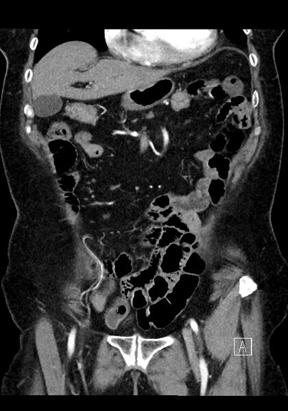 File:Appendiceal hemorrhage (Radiopaedia 70830-81025 C 20).jpg
