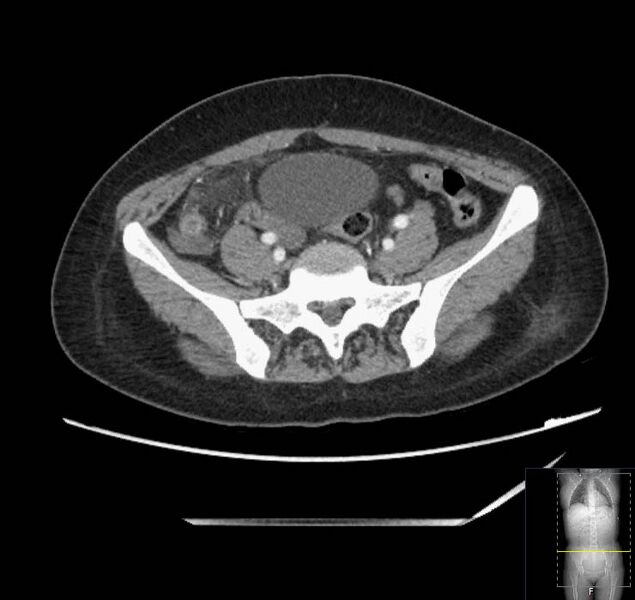 File:Appendicitis (CT angiogram) (Radiopaedia 154713-127660 Axial 13).jpg