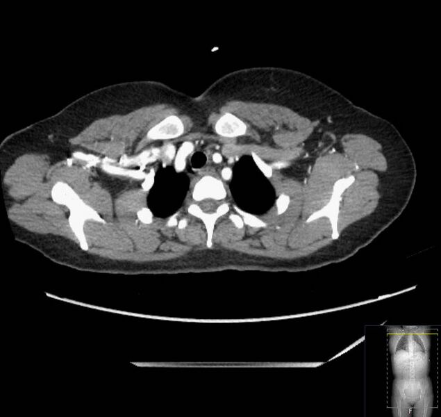 File:Appendicitis (CT angiogram) (Radiopaedia 154713-127660 Axial 233).jpg