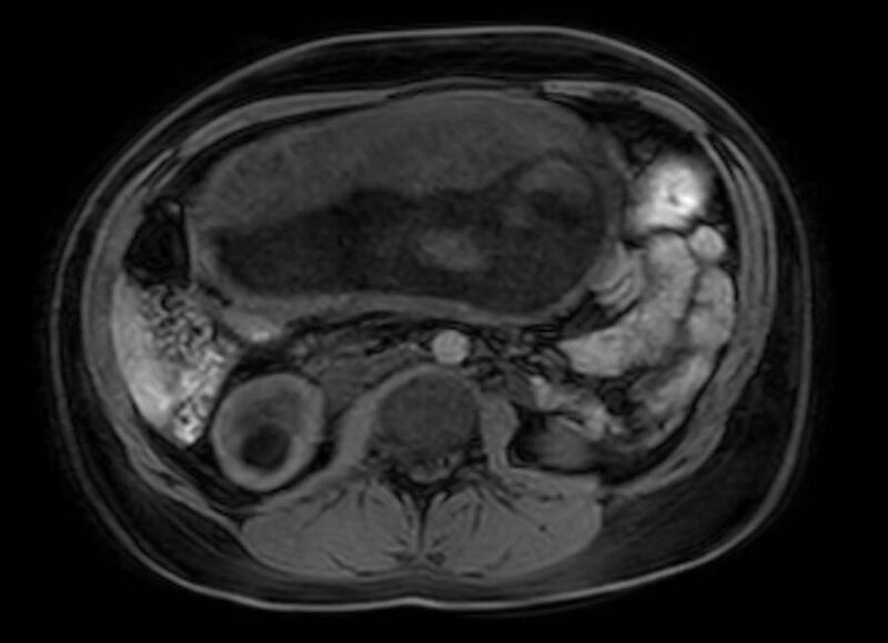 File:Appendicitis in gravida (MRI) (Radiopaedia 89433-106395 Axial DIXON 62).jpg