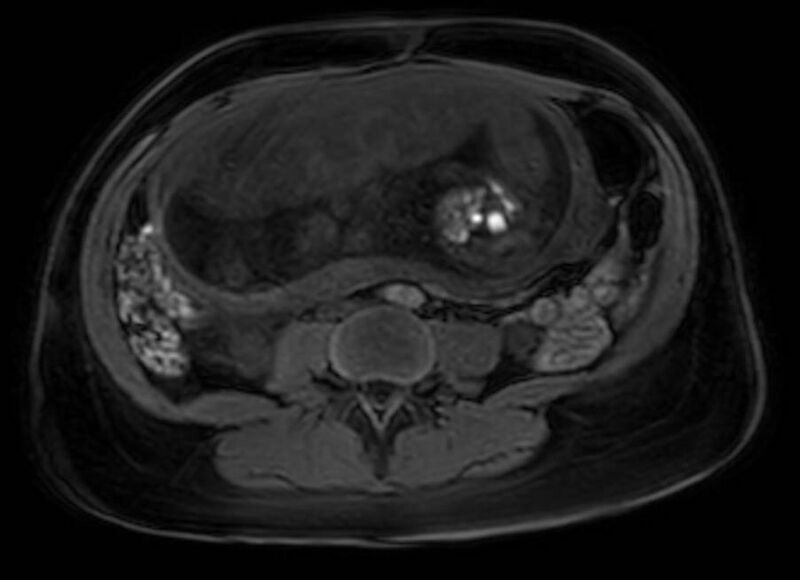 File:Appendicitis in gravida (MRI) (Radiopaedia 89433-106395 Axial DIXON 80).jpg