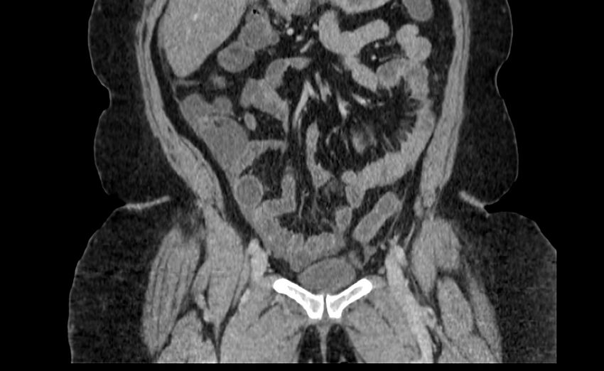 Appendix mucocele (Radiopaedia 41222-44033 B 24).jpg