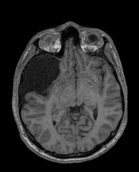 File:Arachnoid cyst- extremely large (Radiopaedia 68741-78451 Axial T1 35).jpg