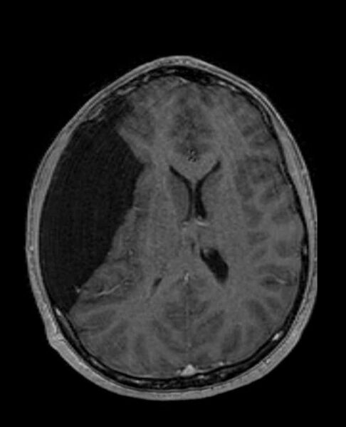 File:Arachnoid cyst- extremely large (Radiopaedia 68741-78451 Axial T1 C+ 48).jpg