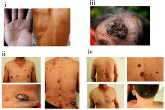 Severities of skin symptoms observed among the 12 individuals in one family with chronic arsenic poisoning