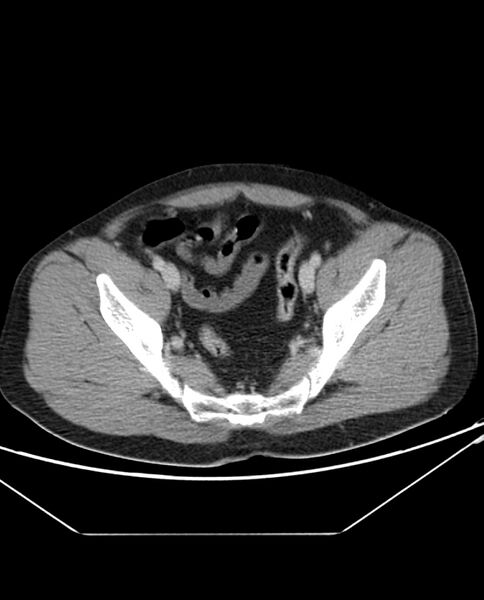 File:Arterial occlusive mesenteric ischemia (Radiopaedia 84641-100054 A 102).jpg