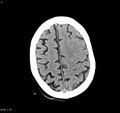 Arteriovenous malformation - cerebral (Radiopaedia 8172-9020 Axial non-contrast 19).jpg