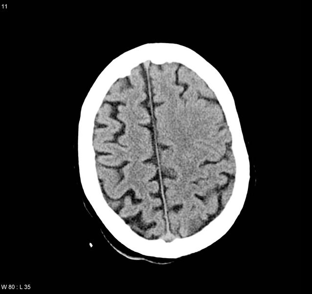 File:Arteriovenous malformation - cerebral (Radiopaedia 8172-9020 Axial non-contrast 19).jpg