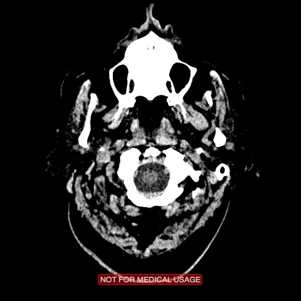 File:Artery of Percheron infarction (Radiopaedia 28679-28967 Axial non-contrast 4).jpg
