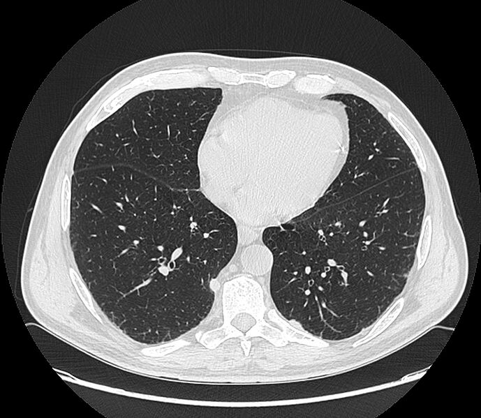 File:Asbestos pleural placques (Radiopaedia 57905-64872 Axial lung window 164).jpg