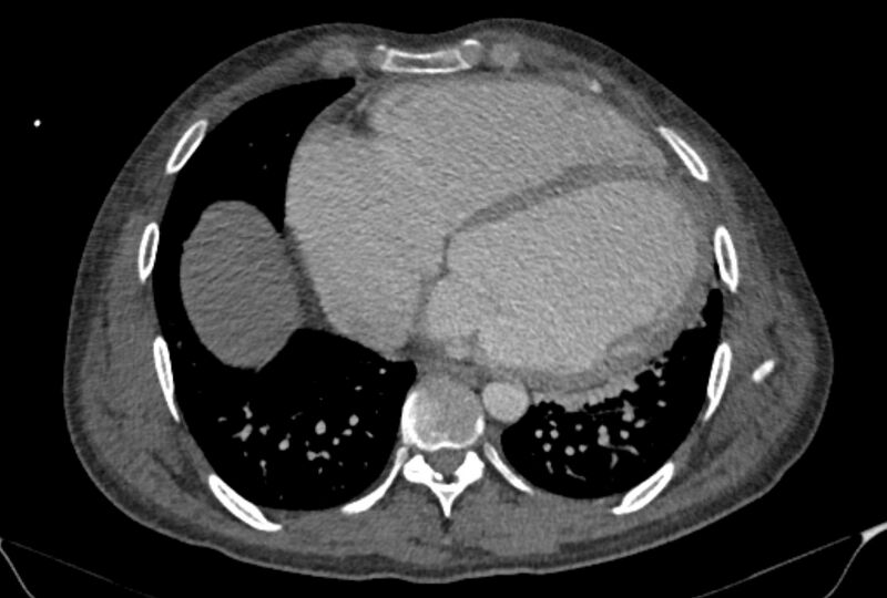 File:Ascending aortic aneurysm (Radiopaedia 86279-102297 C 45).jpg