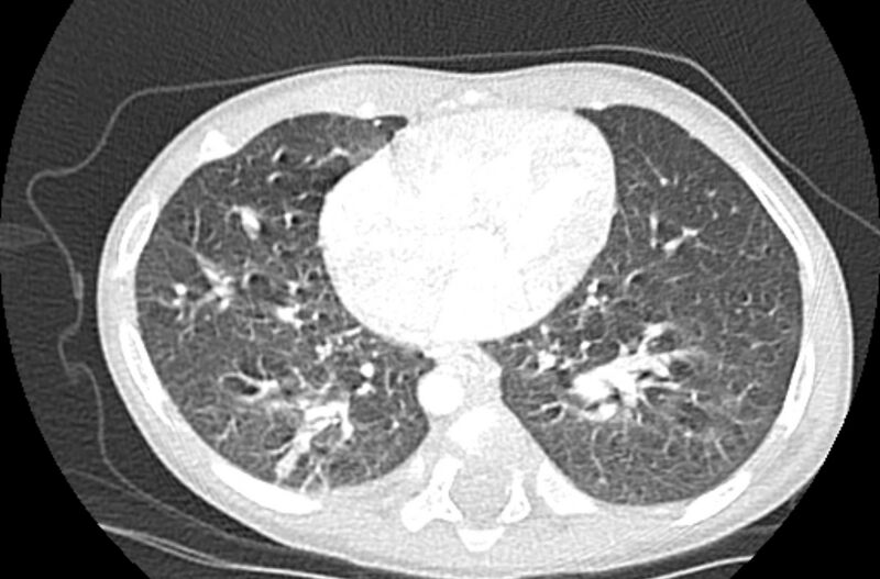 File:Asplenia syndrome (Radiopaedia 73083-83792 Axial lung window 49).jpg
