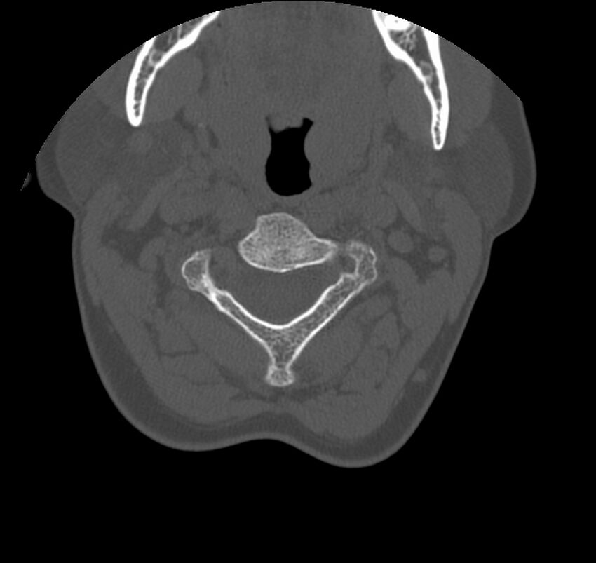 Atlanto-occipital assimilation with basilar invagination (Radiopaedia 70122-80188 Axial bone window 45).jpg