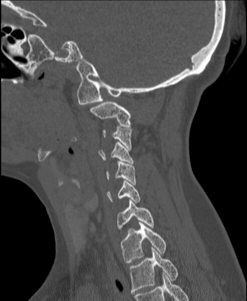 File:Atlanto-occipital assimilation with basilar invagination (Radiopaedia 70122-80188 Sagittal bone window 106).jpg