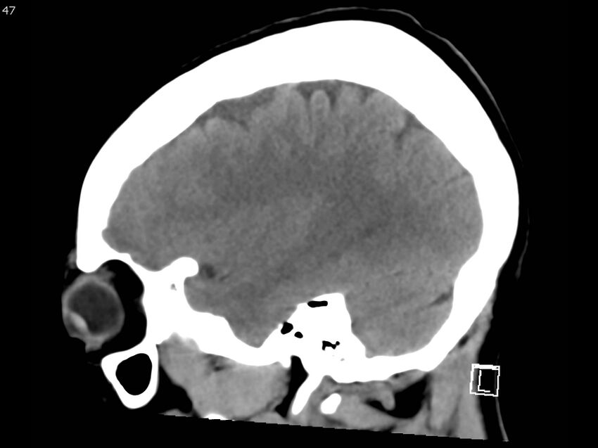 Atypical meningioma - intraosseous (Radiopaedia 64915-73867 C 45).jpg