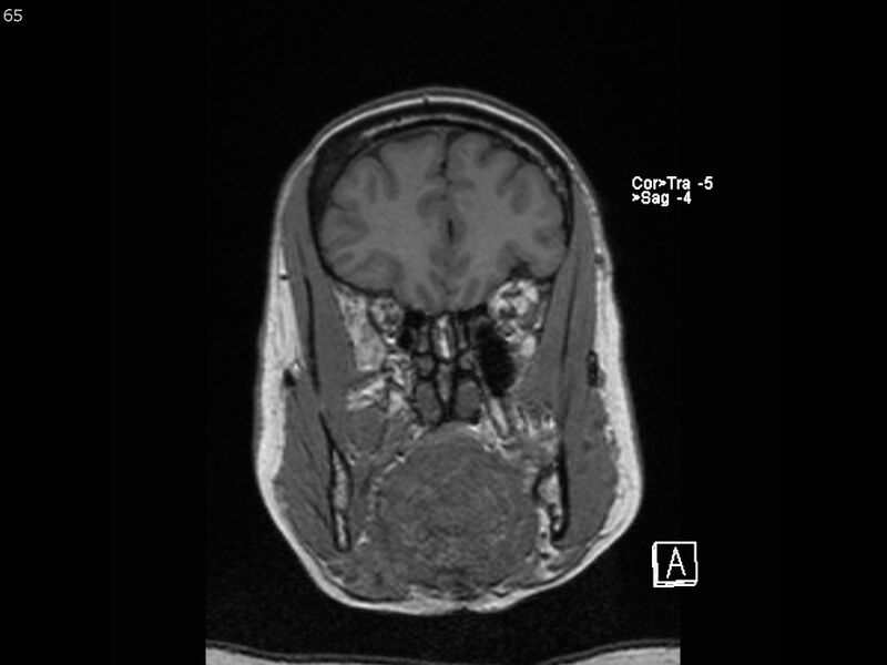 File:Atypical meningioma - intraosseous (Radiopaedia 64915-74572 Coronal T1 65).jpg