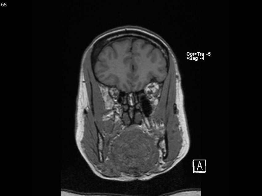 Atypical meningioma - intraosseous (Radiopaedia 64915-74572 Coronal T1 65).jpg