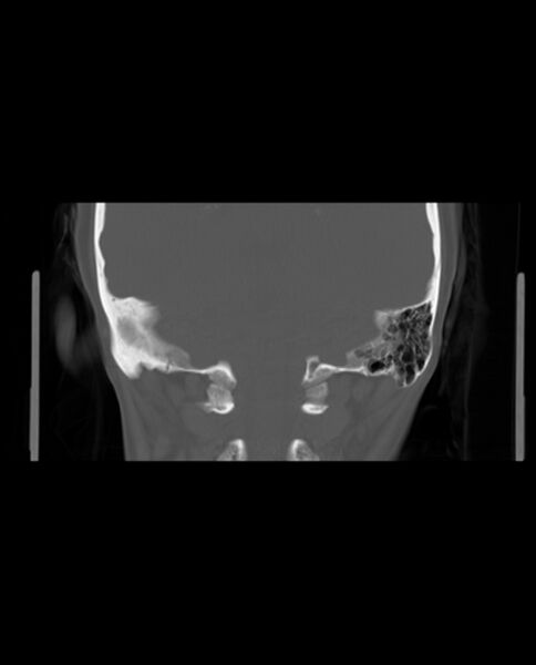File:Automastoidectomy with labyrinthine fistula (Radiopaedia 84143-99411 Coronal non-contrast 112).jpg