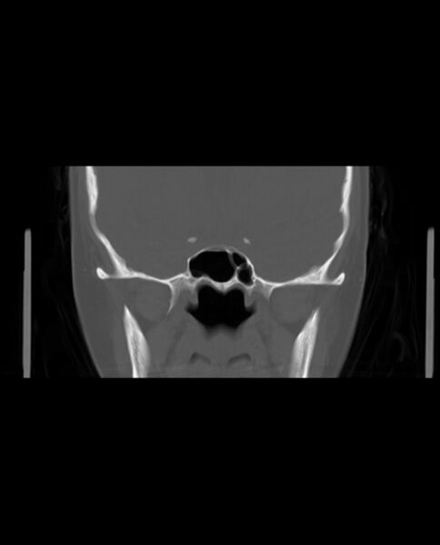 File:Automastoidectomy with labyrinthine fistula (Radiopaedia 84143-99411 Coronal non-contrast 68).jpg
