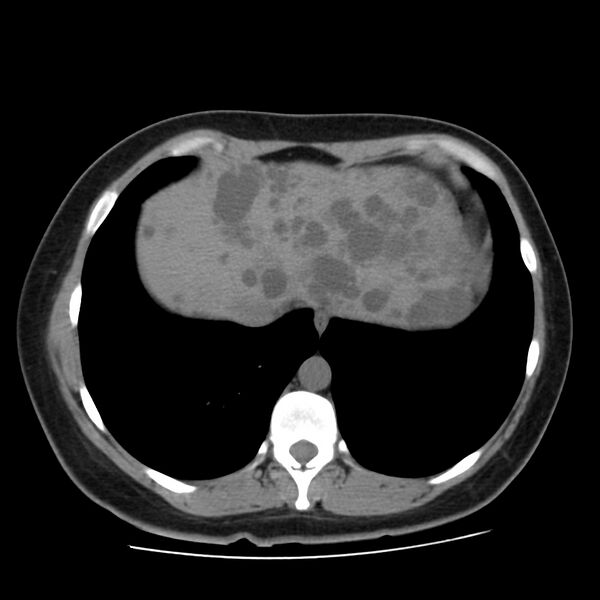 File:Autosomal dominant polycystic kidney disease (Radiopaedia 23061-23093 Axial non-contrast 6).jpg