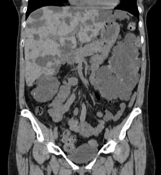 File:Autosomal dominant polycystic kidney disease (Radiopaedia 41918-44922 Coronal non-contrast 12).jpg
